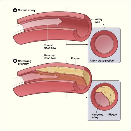 Stent Placement in Kolkata