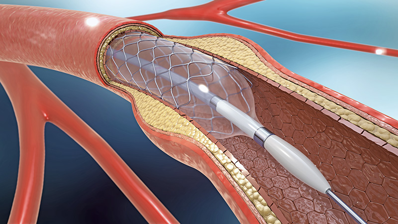 Coronary Intervention in Kolkata