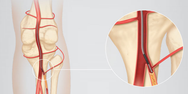 Peripheral Intervention in Kolkata