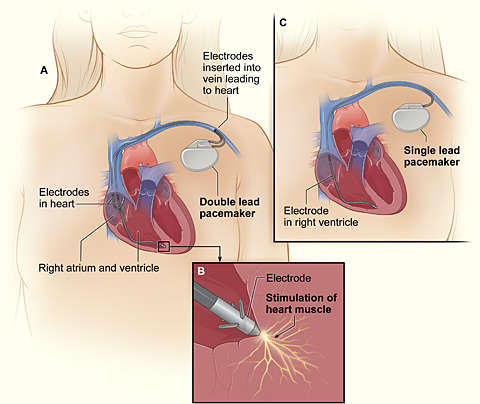 Permanent Pacing in Kolkata