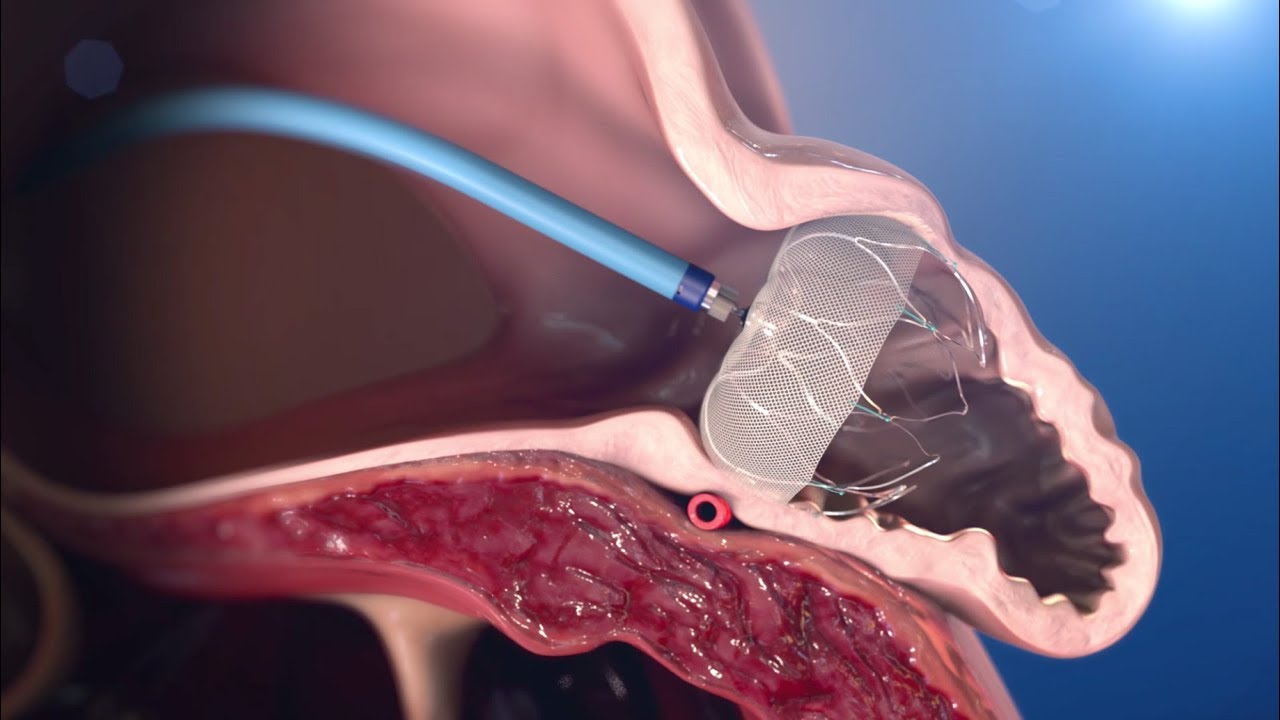 Cardiac Device Implantation in Kolkata